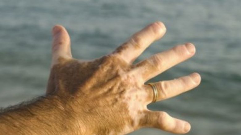 Vitiligo: O Boală de Piele cu Beneficii Ascunse în Lupta Împotriva Cancerului
