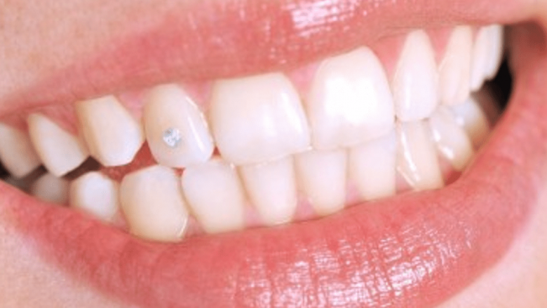Bijuteriile dentare: O tendință în creștere printre adolescenți – Beneficii și riscuri