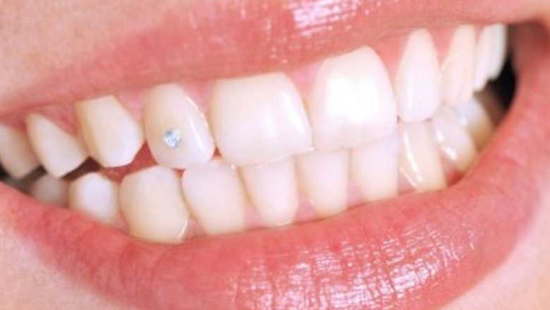 Bijuteriile dentare: între estetică și sănătate – Ce trebuie să știe adolescenții