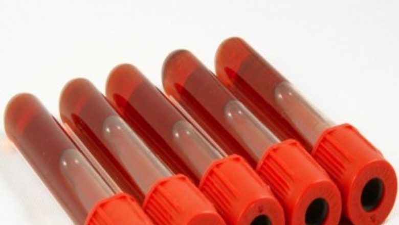 Inovație în diagnosticul sclerozei multiple: Testul de sânge promite depistare timpurie