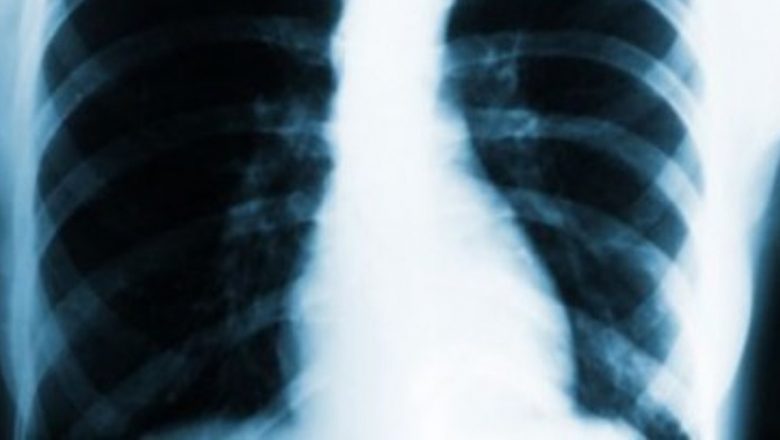 Tuberculoza: O Cursă Împotriva Timpului – Impactul și Provocările Înfruntării Unei Maladii Învechite