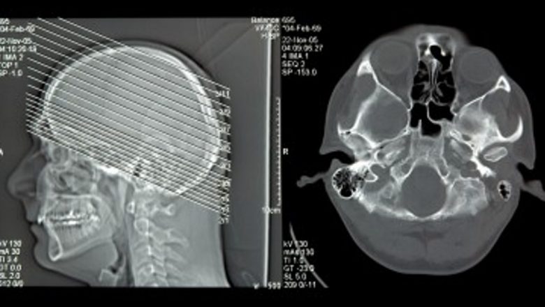 O Provocare Medicală: Intervenția Revoluționară asupra unei Tumori Cerebrale Gigante la un Copil de 2 Ani