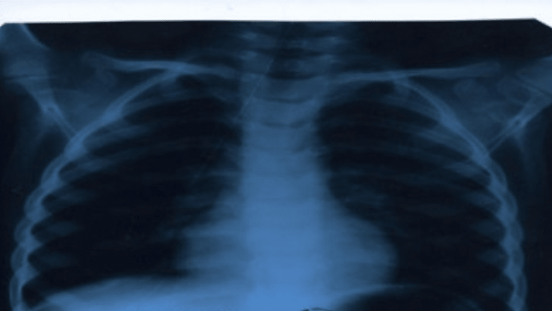 Inovație în Diagnosticul Tuberculozei: Teste Rapid și Impact Global