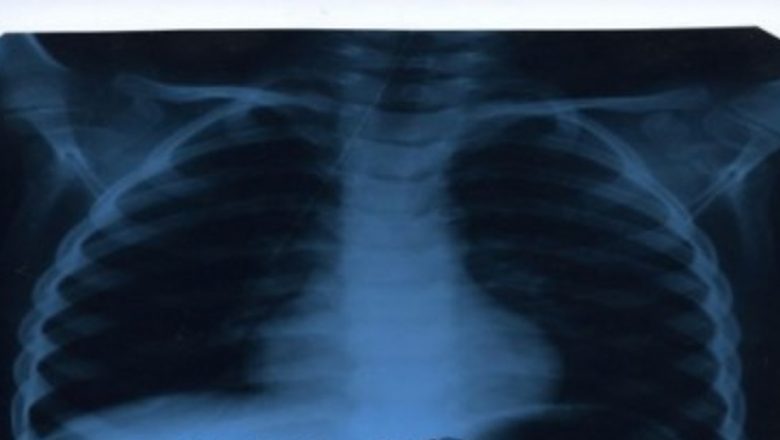 Revoluția diagnosticării tuberculozei: un test rapid de 100 de minute