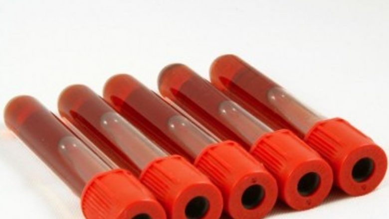 Impactul colesterolului crescut în adolescență asupra sănătății pe termen lung