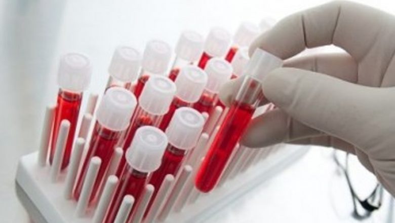 Impactul HIV asupra sănătății cerebrale: Riscurile accidentelor vasculare în rândul persoanelor seropozitive