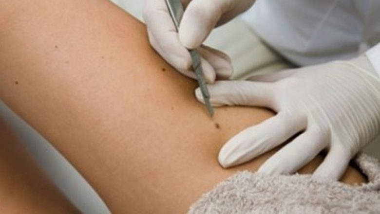 Importanța Examinării Alunițelor: Campania Gratuită pentru Prevenția Cancerului de Piele