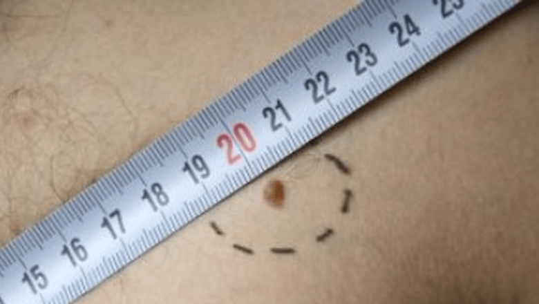 Importanța Consultațiilor Dermatologice: Prevenția Melanomului și Impactul Expunerii la Radiații UV