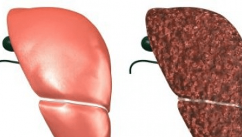 Inovații Promițătoare în Tratamentul Tumorilor Maligne Hepatice: Chemoembolizarea cu Microsfere Absorbabile