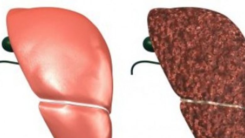 Inovații în Tratamentul Tumorilor Maligne Hepatice: Chemoembolizarea cu Microsfere Absorbabile