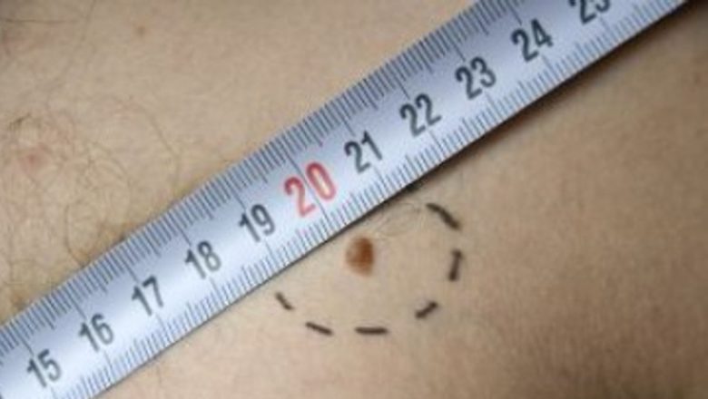Importanța Consultațiilor Dermatologice Gratuite: Oportunități pentru Prevenirea Melanomului Malign