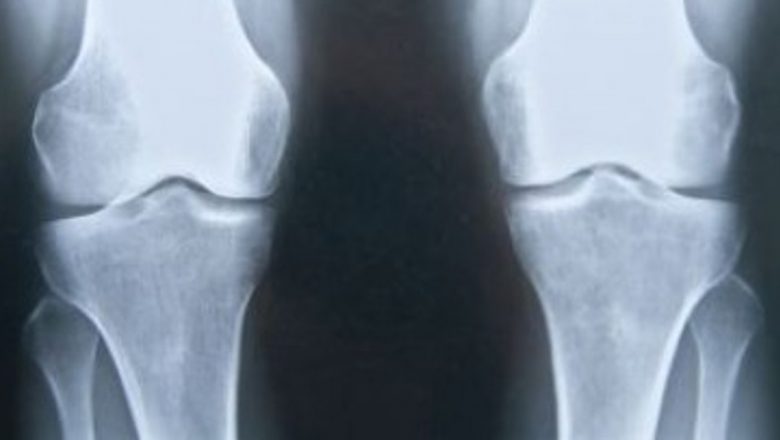 Regenerarea oaselor: O nouă speranță prin terapia genică