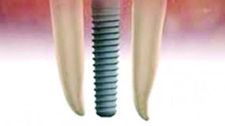 Implanturi dentare versus punți dentare: Alegerea optimă pentru sănătatea orală