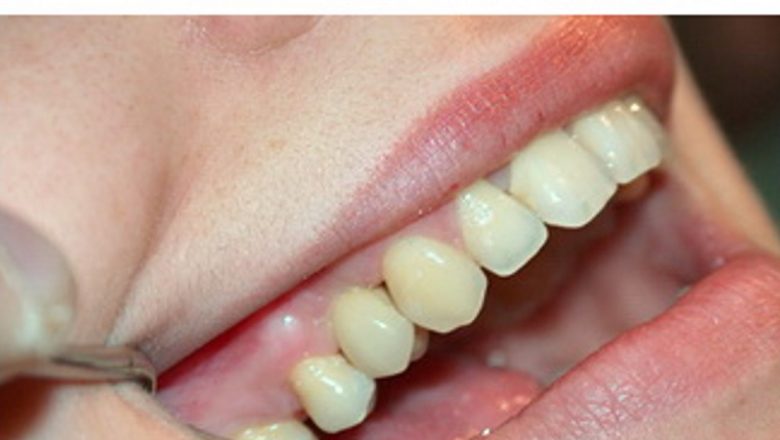 Tot ce trebuie să știți despre implanturile dentare: o soluție modernă pentru zâmbetul dumneavoastră
