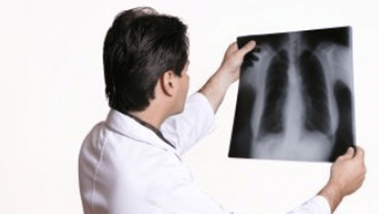 Campania de Informare privind Cancerul Pulmonar: O Luptă Esențială pentru Sănătatea Publică
