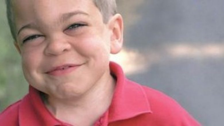 Sindromul Hunter: O privire detaliată asupra unei afecțiuni rare și impactul acesteia asupra vieții pacienților