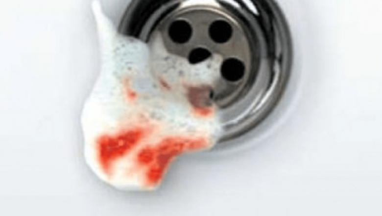 Impactul Sângerării Gingiilor asupra Sănătății Dentare și Generale