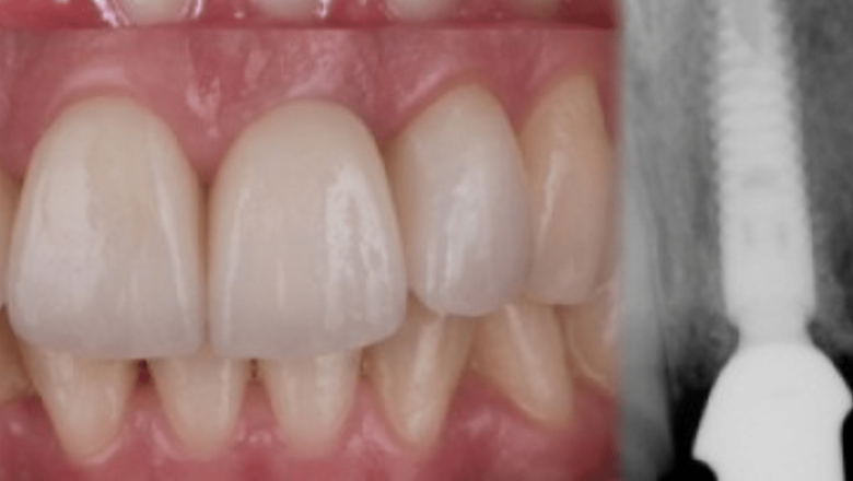 Implanturile Dentare: Tot Ce Trebuie Să Știi Despre O Soluție Modernă pentru Dinții Lipsă