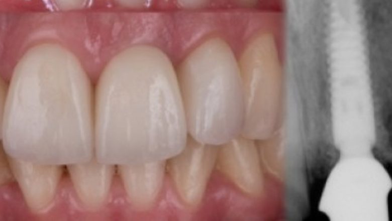 Implanturile dentare: Tot ce trebuie să știi despre soluția modernă pentru dinții lipsă