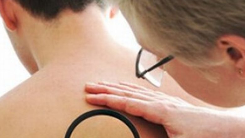 Legătura dintre consumul de alcool și riscul crescut de cancer de piele: O analiză detaliată