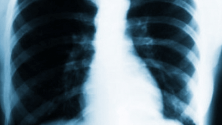 Riscurile ascunse ale substanțelor antioxidante: O nouă perspectivă asupra cancerului pulmonar