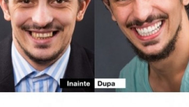 Revoluția Estetică și Funcțională: Tratamentul Modern cu Implanturi Dentare și Fațete Dentare