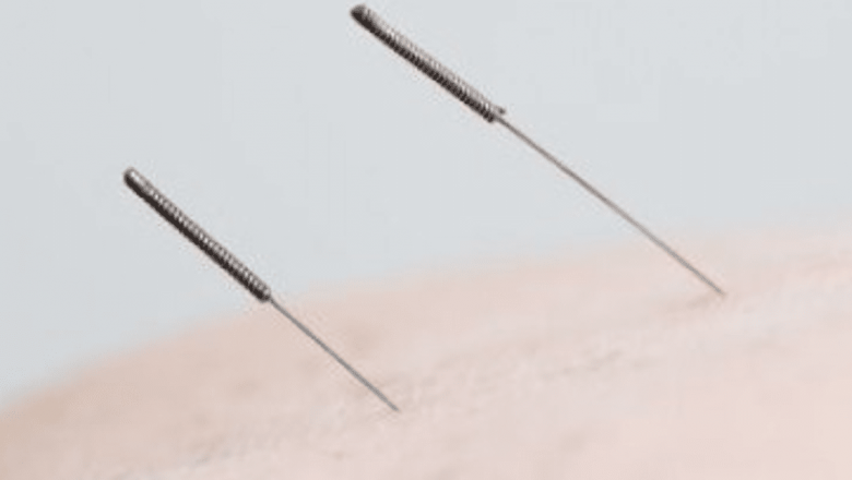 Acupunctura: O abordare inovatoare în lupta împotriva kilogramelor în plus