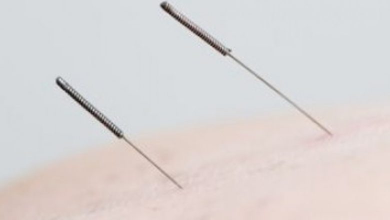 Acupunctura: O abordare inovatoare în lupta împotriva kilogramelor în plus