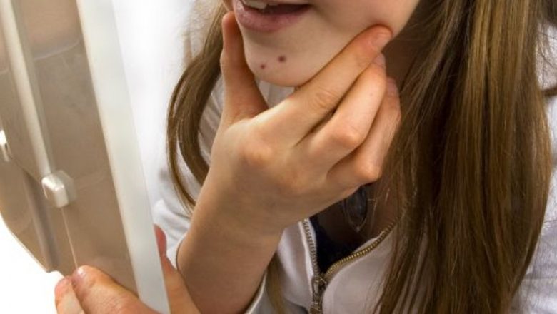 Atenție la Alunițele Suspecte: Semne, Riscuri și Importanța Consultului Medical