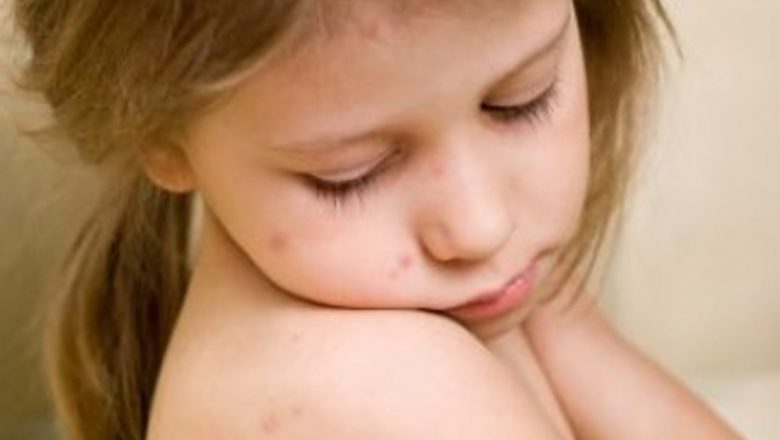 Ghid complet pentru tratarea scarlatinei la copii: simptome, tratament și prevenție