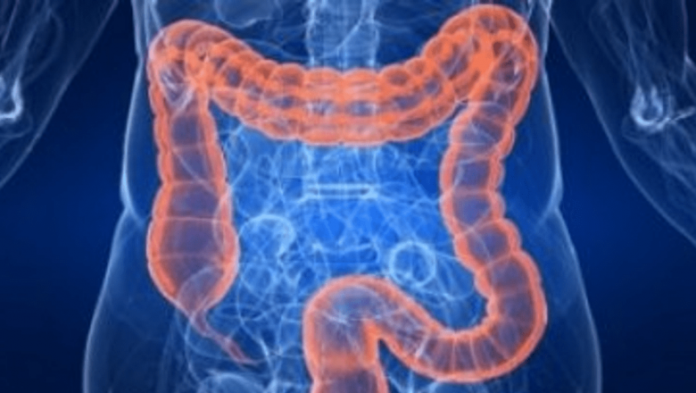 Vitamina D: O Apărare Naturală Împotriva Cancerului de Colon