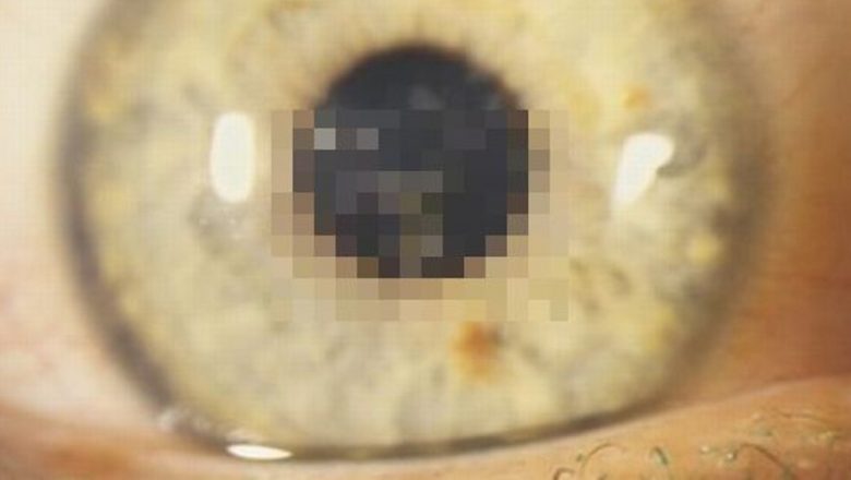 Riscurile ascunse ale purtării lentilelor de contact: Ce trebuie să știm pentru o sănătate oculară optimă