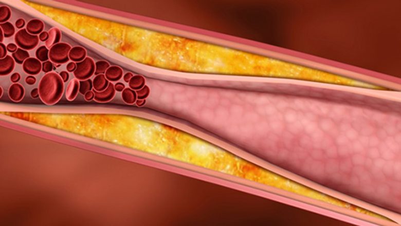 Semnele tăcute ale înfundării arterelor: Cum să îți protejezi sănătatea cardiovasculară