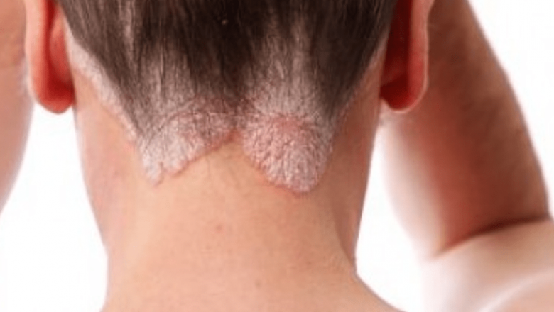 Psoriazisul: Înțelegerea și Gestionarea Afecțiunii pe Timpul Verii