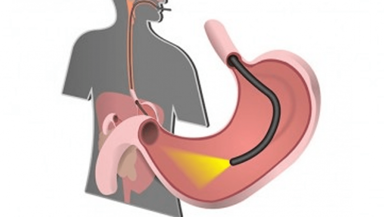 Ghidul Complet al Endoscopiei: Indicații, Proceduri și Implicații pentru Sănătate