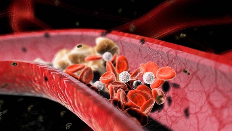 Colesterolul crescut: O amenințare silențioasă pentru sănătatea ta și legătura sa cu cancerul