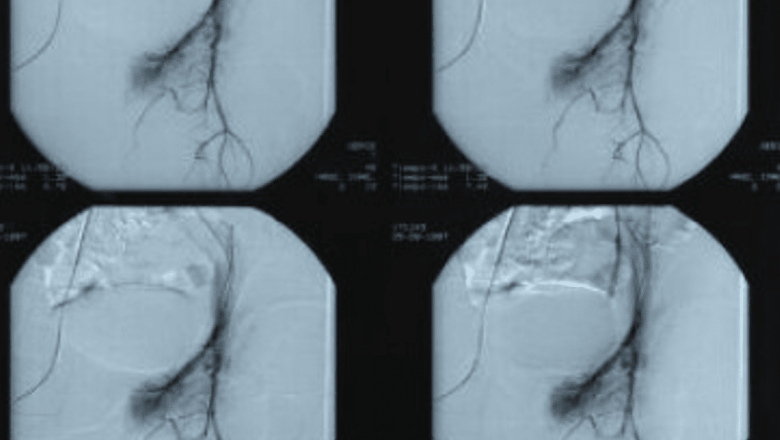 Arteriografia: O Privire Detaliată Asupra Procedurii și Implicațiilor Sale