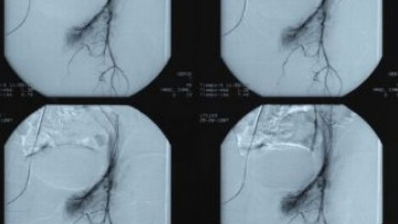 Arteriografia: O Privire Detaliată asupra Unui Instrument Vital de Diagnosticare