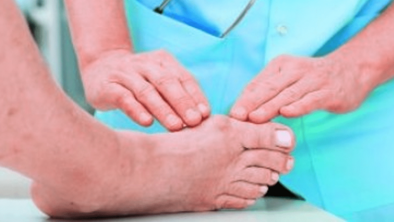 Monturile: Cauze, Simptome și Opțiuni de Tratament pentru Afecțiunea Hallux Valgus