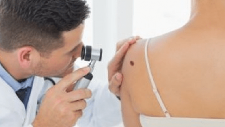 Creșterea alarmantă a cazurilor de cancer de piele: O problemă globală în expansiune