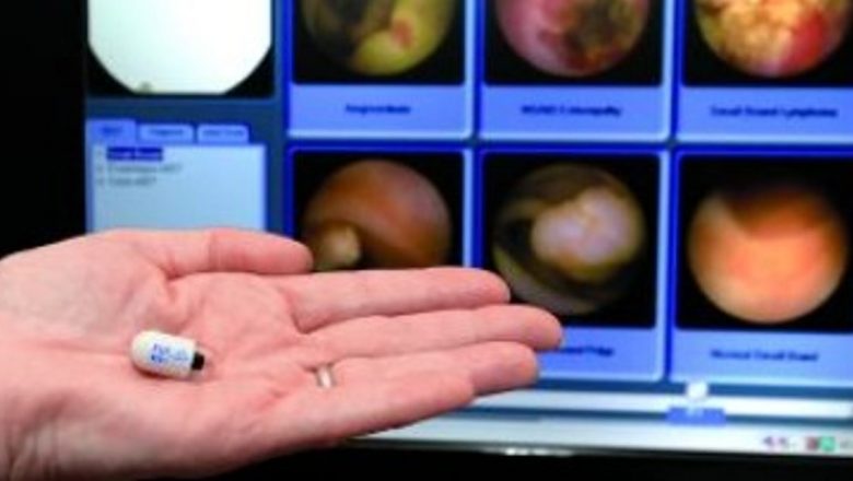 Videocapsula Endoscopică: Inovația în Diagnosticul Afecțiunilor Digestive