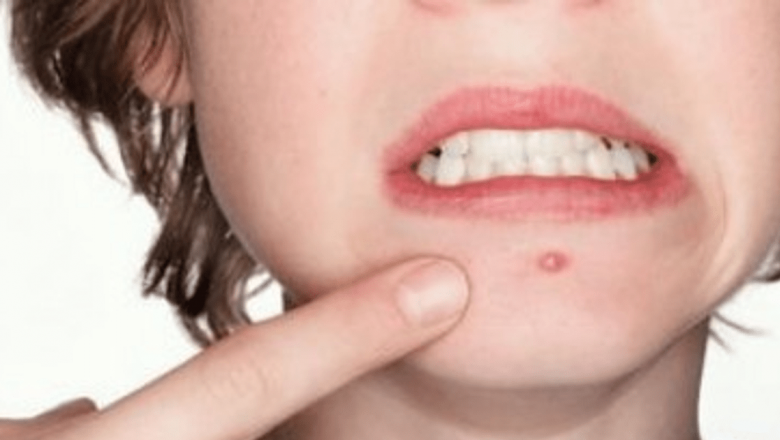 Evaluarea Gratuită a Acneei: O Inițiativă Benefică pentru Sănătatea Dermatologică