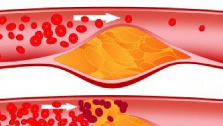 Colesterolul: Înțelegerea Complexității și Importanței Sale pentru Sănătatea Noastră