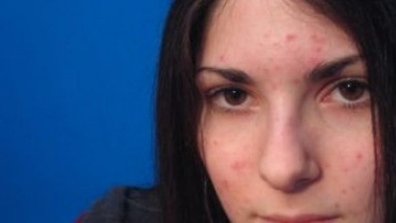 Ghid complet pentru tratarea cicatricilor lăsate de acnee: soluții personalizate și perspective psihologice