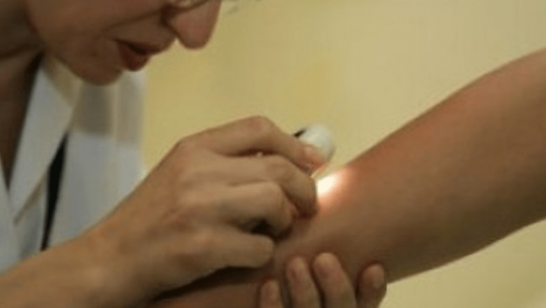 Importanța verificării alunițelor: Campania Zilele Protecției Solare și prevenția cancerului de piele