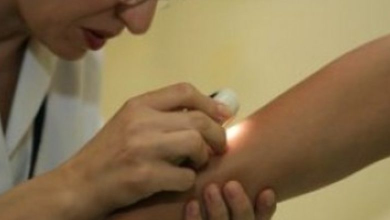 Prevenția cancerului de piele: Importanța verificării alunițelor și a protecției solare