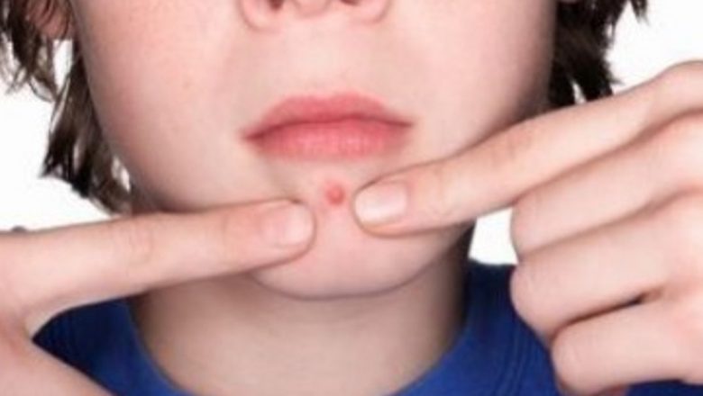 Ghid Complet pentru Îndepărtarea Furunculelor: Remedii Naturale și Sfaturi Practic