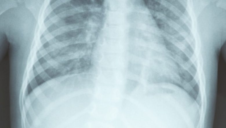 Tipurile de cancer cu cel mai mare risc de recidivă: O analiză detaliată