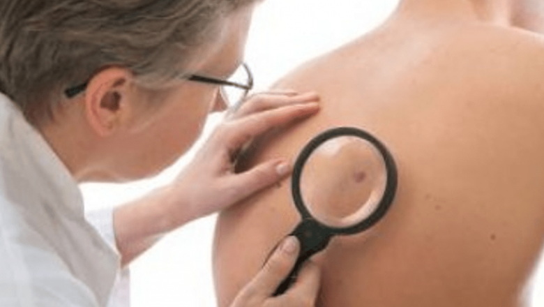 Cancerul de piele: Ghid complet pentru o vară fără riscuri