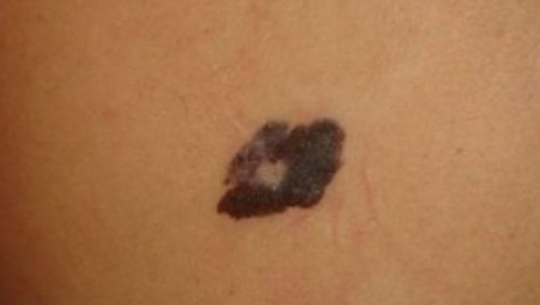 Descoperirea unui mecanism de blocare a metastazelor: Progrese promițătoare în lupta împotriva melanomului